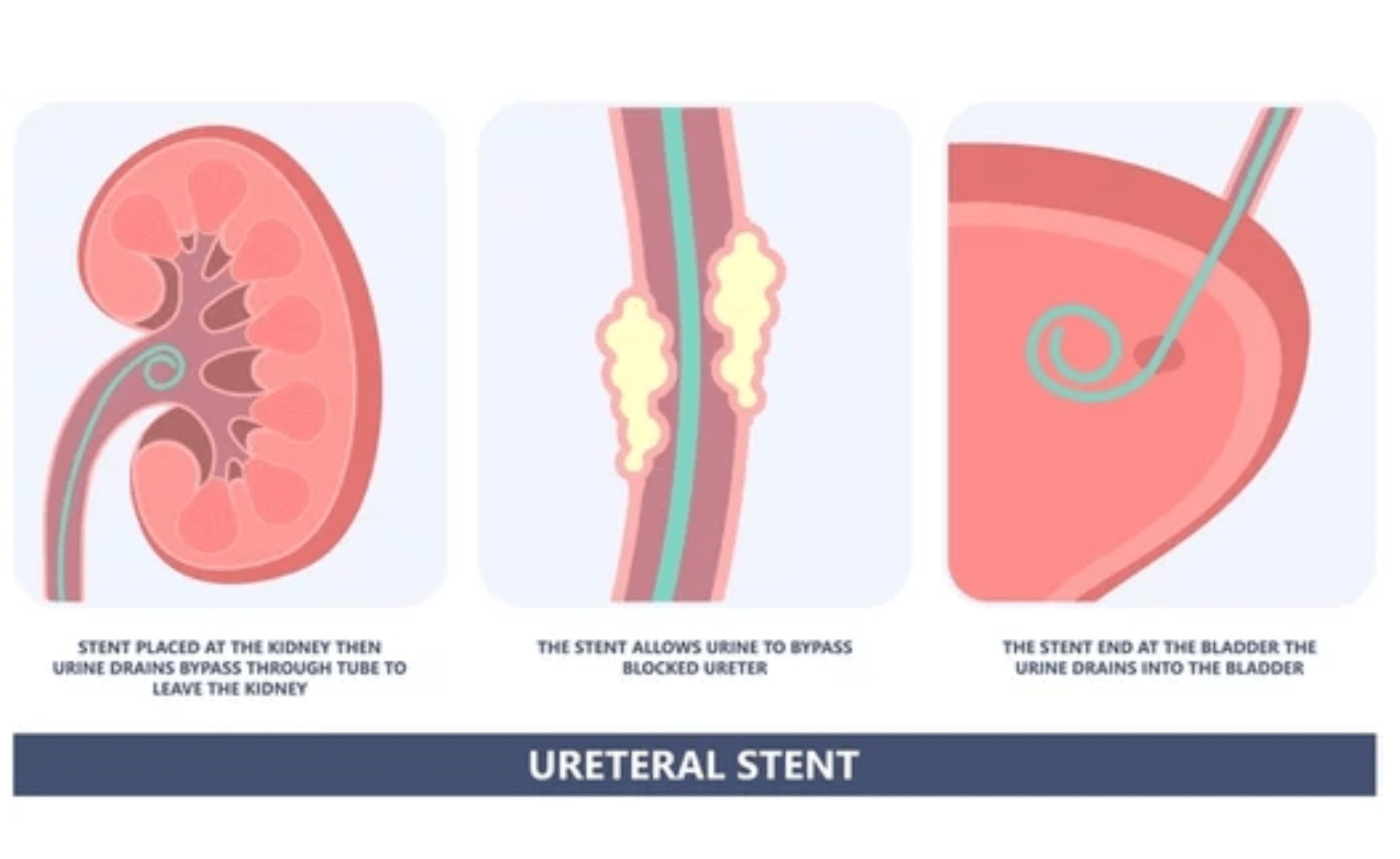 Ουρητηρικό stent (pigtail) | Ανδρέας Σκολαρίκος | Ουρολόγος Αθήνα